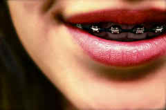 white spots from braces